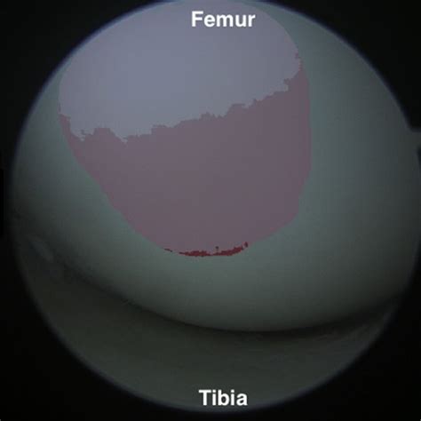 Arthroscopic View Of The Anterolateral Femoral Condyle As Viewed From