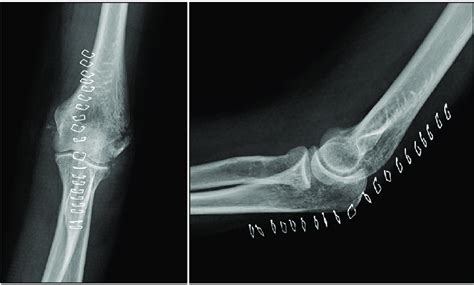 Anteroposterior Radiograph And Lateral Radiograph Of The Left Elbow