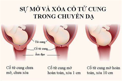 Dấu Hiệu Chính Xác Của Việc Chuyển Dạ Vinmec