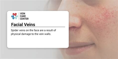 Facial Vein Removal In Nyc And Nj Vein Care Center