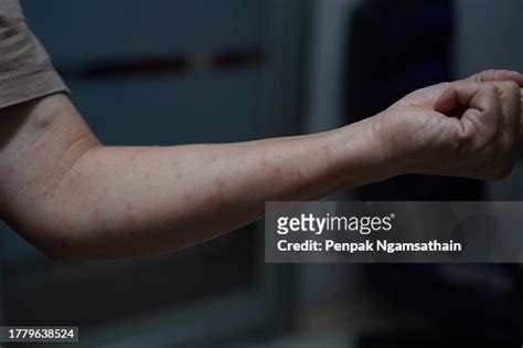 Red Swollen Rash On The Arm High Res Stock Photo Getty Images