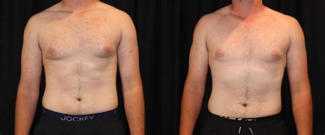 Coolsculpting Before And After Pictures Case 50 Sacramento Ca