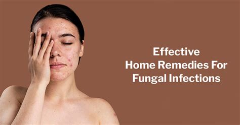 12 Effective Home Remedies For Fungal Infections