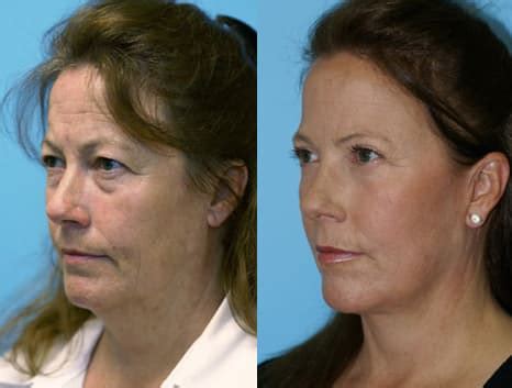 Jowls Plastic Surgery Before And After