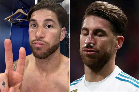 Real Madrid Star Sergio Ramos Shares Image Of His Healing Nose After