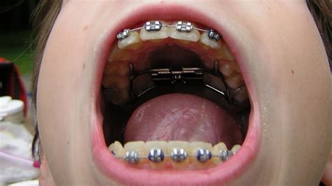 What Is The Best Age To Get Braces Youtube