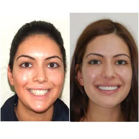 Invisalign Before And After Overbite