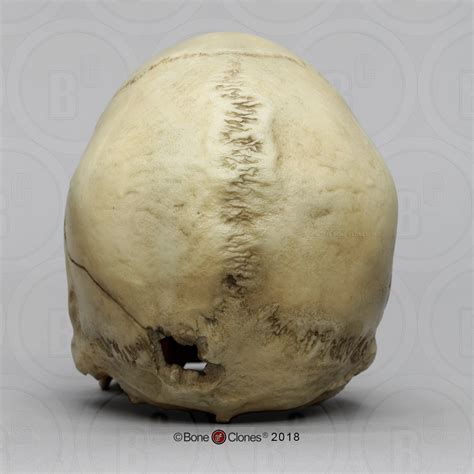 Human Male Skull With A Caliber Gunshot Wound Bone Clones Inc Osteological Reproductions