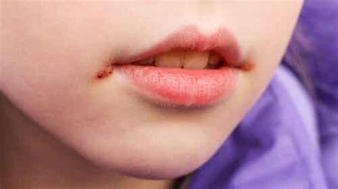 Mouth Sores In Children Causes And Treatment You Are Mom