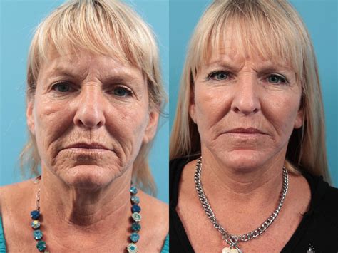 Halo® Laser Skin Resurfacing West Des Moines And Ames Koch And Carlisle