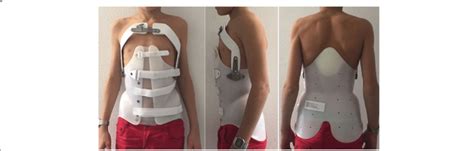 The Anti Gravity Brace Used For The Treatment Of Scheuermann S Kyphosis Download Scientific