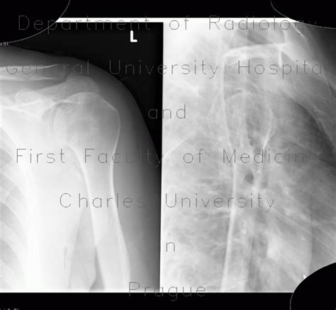 Radiology Case Calcified Axillary Lymph Nodes