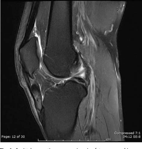 Figure 1 From Diagnosis And Treatment Of Patellar Tendon Gouty Tophus