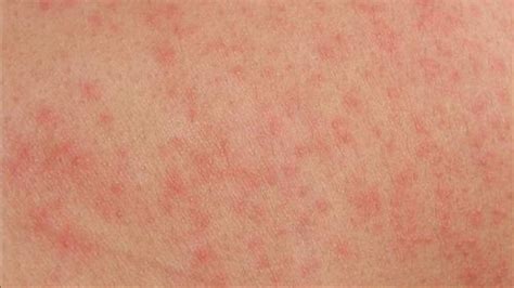 Résumé De 25 Articles Sur Le Sujet Allergie Cutanée Que Faire