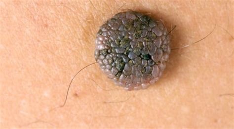 What Is Moles Causes Symptoms And Homeopathic Treatment