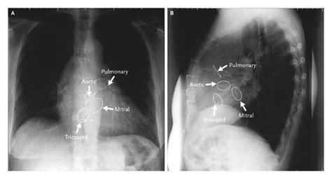 Four Artificial Heart Valves Nejm