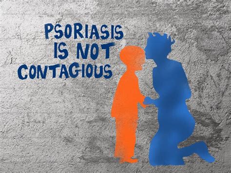 Psoriasis Is Not Contagious Dr Health Clinic Homepage