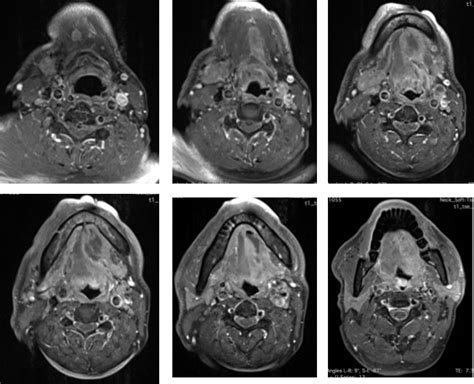 Adenoid Cystic Carcinoma Of Salivary Gland Sublingual Radiology Cases