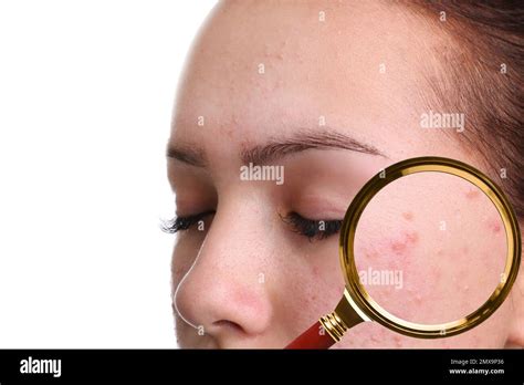 Teenage Girl With Acne Problem On White Background Closeup Skin Under
