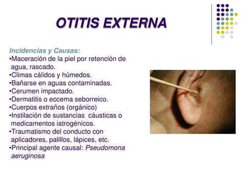 Ppt Otitis Powerpoint Presentation Free Download Id4511398