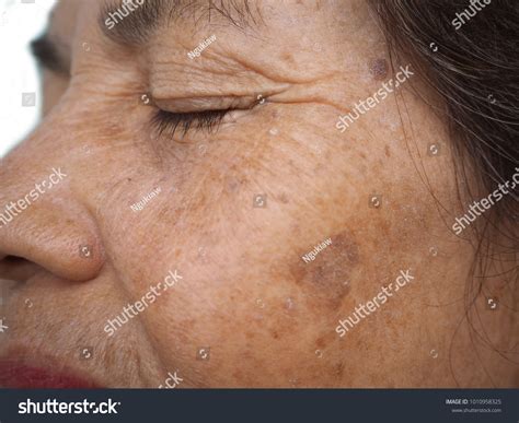 Close Old Woman Face Melasma Freckle ภาพสต็อก 1010958325 Shutterstock