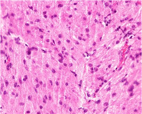 Figure 1 From Granular Cell Tumor Presenting With Perforation Of Fourth