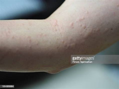 Red Rash Arm Fotografías E Imágenes De Stock Getty Images