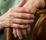 Rheumatoid Arthritis On One Side Of Body Images