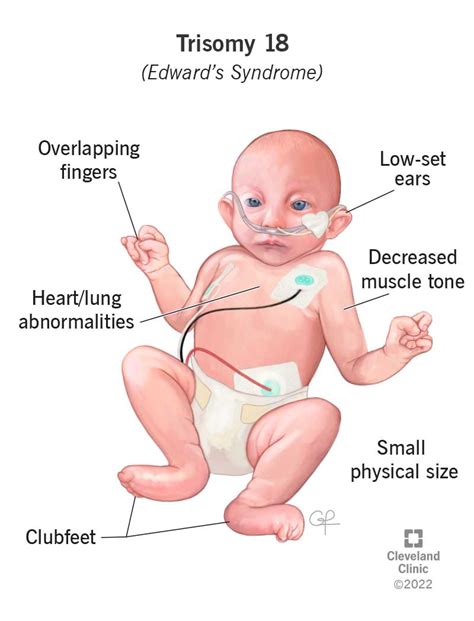 Edwards Syndrome Trisomy 18 Genetic Condition Symptoms And Outlook