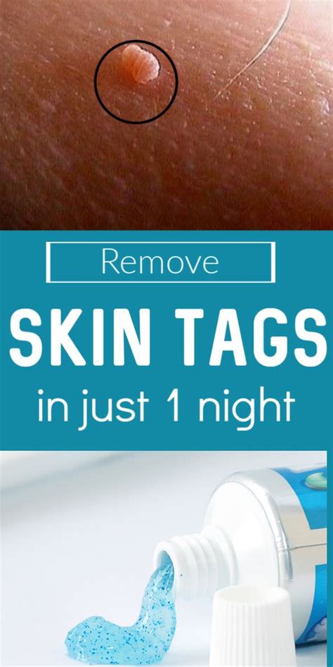 How To Remove Skin Tag In 1 Night Wellnessdot