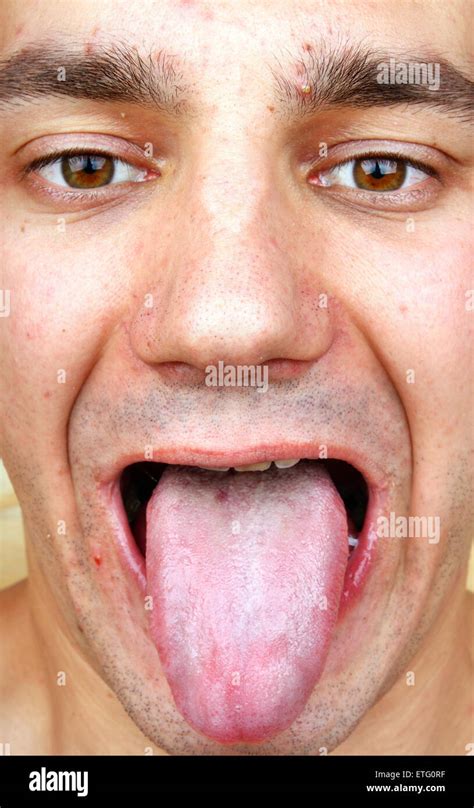 Bacterial Infection Disease Tongue And Herpes On The Face Of A Man