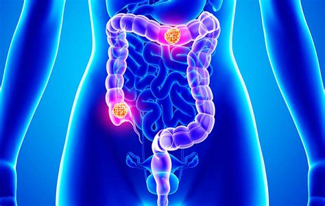When your colon is healthy, it will efficiently remove the waste your. COLON-RETTO - Aucc