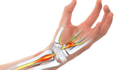Carpal Tunnel Syndrome Genesis Orthopaedic And Spine Sports Medicine
