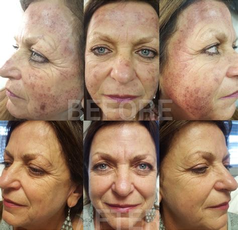 Face Discoloration Treatment Doctor Heck