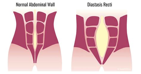 Diastasis Recti Pregnancy Also Known Diastasis Rectus Abdominus