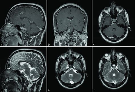 Preoperative Mri Images A Sagittal T1 Weighted Contrast Enhanced