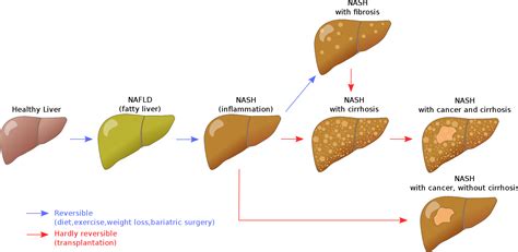 Understanding Non Alcoholic Fatty Liver Disease Ketonutrition