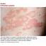 Chronic Urticaria It’s More Than Just Antihistamines  Clinician Reviews
