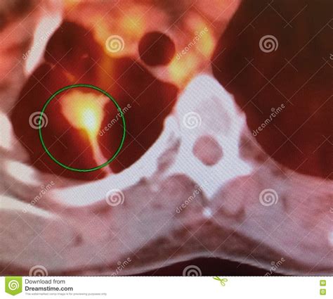 Ct Scan Right Lung Lower Lobe Carcinoma Royalty Free Stock Photo