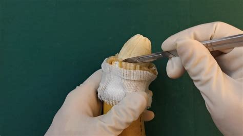 Circumcision Stapler Non Surgical Male Circumcision P Vrogue Co