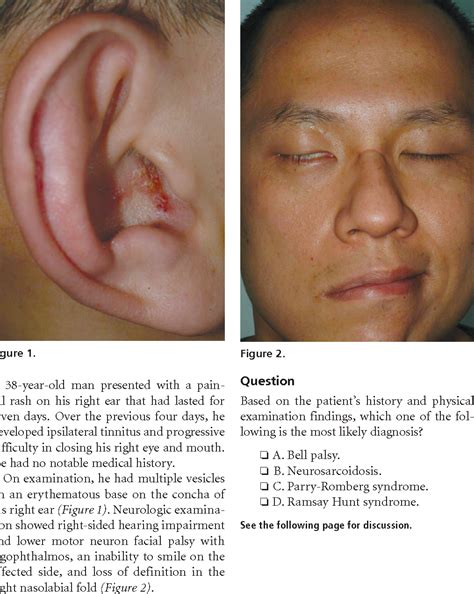 Figure 1 From Facial Palsy In A 38 Year Old Man Ramsay Hunt Syndrome