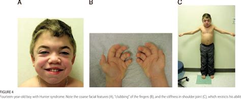 Recognition And Diagnosis Of Mucopolysaccharidosis Ii Hunter Syndrome