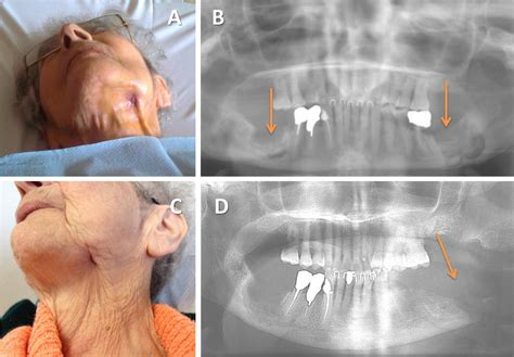 Bilateral Bisphosphonate Related Osteonecrosis Of The Jaw With Left