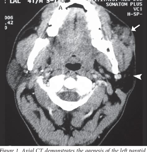 Figure From Unilateral Parotid Agenesis Associated With Pleomorphic Adenoma Of Ipsilateral