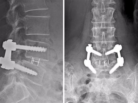 Keyhole Spine Surgery Saved 79 Year Olds Back And Sanity Today