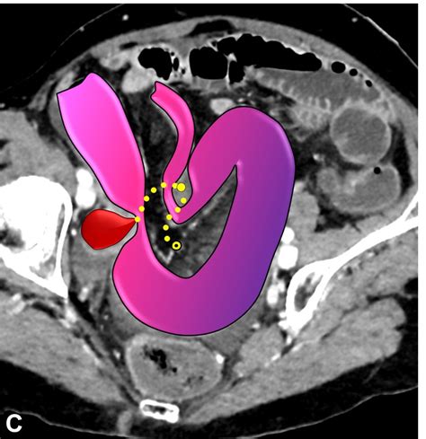 Radiographics On Twitter Laparoscopic Sacrocolpopexy And Rectopexy Are Commonly Used Surgical