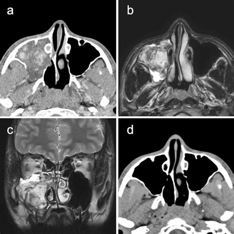 Figure2imaging Findings For Case 3 Axial Image From Preoperative