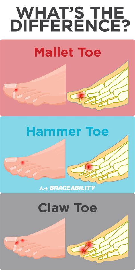 Mallet Toe Hammer Toe And Claw Toe Are Foot Deformities That Are