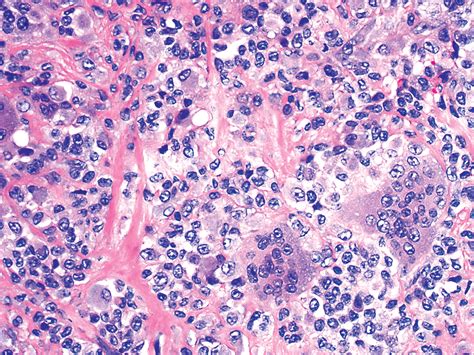 Pathology Outlines Giant Cell Granuloma