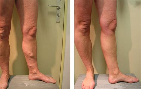 Residual Varicose Veins Below The Knee After Varicose Vein Surgery Are